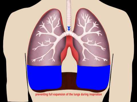 how to drain fluid from lungs