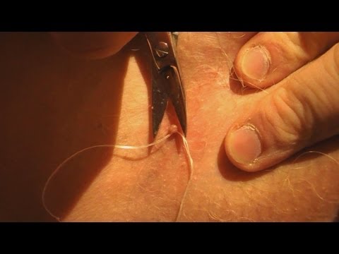 how to remove a skin tag