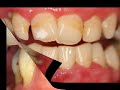 Gum disease is the main cause of tooth loss.