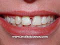 Estética dental: espacios entre dientes (problema/solución)