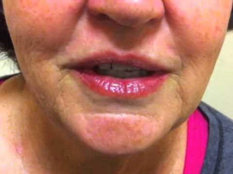 how to treat ms headaches