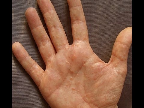 how to treat dyshidrosis