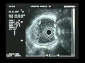 Endoscopic Ultrasoud - Artefact, Reflex Endoscopic Ultrasoud - Artefact, Reflex