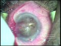 CLEAR CORNEAL CATARACT SURGERY IN GUYANA