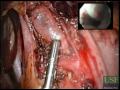 Laparoendoscopic Single Site (LESS) Heller Myotomy & Anterior Fundoplication
