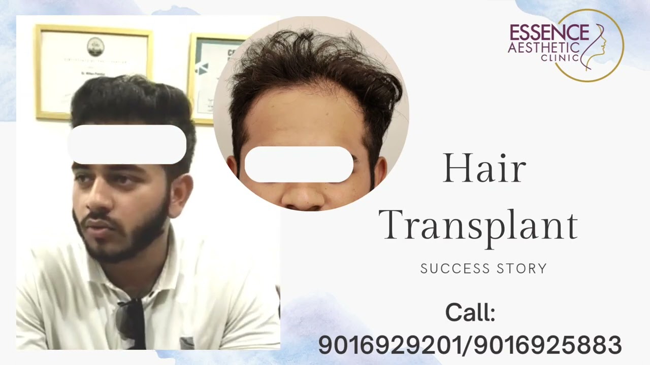 Baroda number 1 hair transplant clinic #hairlosssolution  #hairtransplant  #hairtransplantclinic