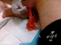 GRAPHIC Removal of gauze strip packing.