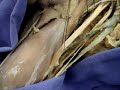 Plexo Braquial Plexo Braquial