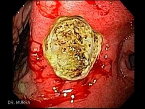 how to treat nsaid induced ulcers