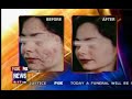 Isolaz Painless Acne Therapy News Segment Isolaz Painless Acne Therapy News Segment