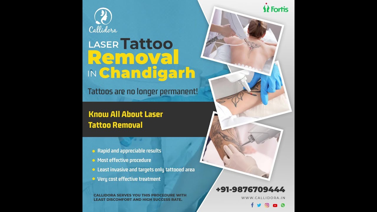 Tattoo Removal - Callidora Laser Clinic | Tattoo Removal | Tattoo Removal by  laser | Skin Care |