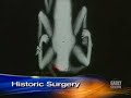 Parasitic Twin Separation (CBSNews) Parasitic Twin Separation (CBSNews)