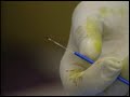 endovenous laser treatment (evlt) with Dr. Steven E. Zimmet