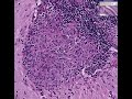 Histopathology Brain, cerebellum--Sarcoidosis Sarcoidosis
