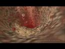AstraZeneca-atherosc