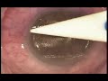 Lasik with Hansatome  Laser Eye Surgery Refractive Errors