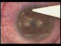 Lasik with Hansatome Lasik with Hansatome