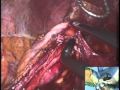 LaparoEndoscopic Single-Site Surgery (LESS):  Radical Nephrectomy