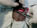 Ablacion de tumor en la piel - video #1