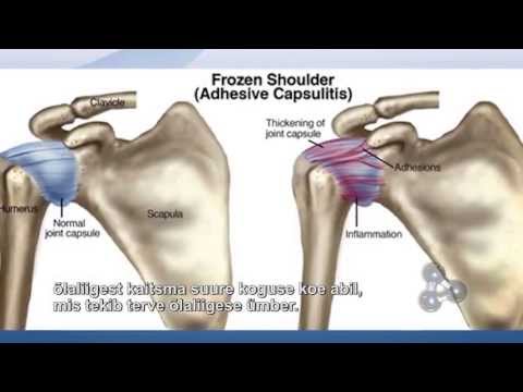 how to cure frozen shoulder