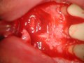 apical surgery, endodontics, piezo surgery, THIERRY ROOS apical surgery, endodontics, piezo surgery, THIERRY ROOS