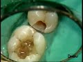 Restauraci�n de Posteriores Dr. P.Colon - Quixfil /1