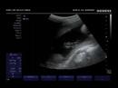 Lee Shaianne Sonogram 160707