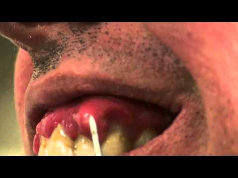 how to drain abscess tooth at home
