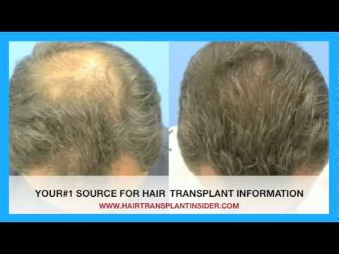 how to do hair transplant yourself
