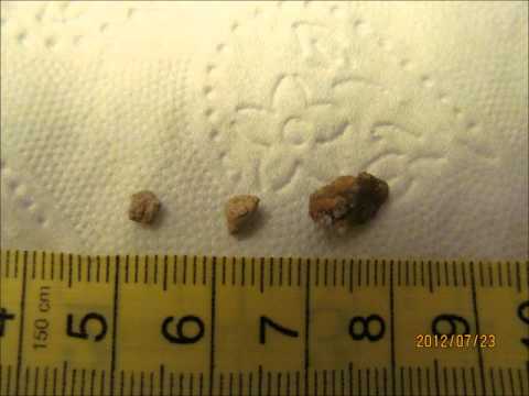 how to dissolve large kidney stones