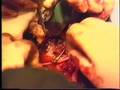 Vascular stapler in experimental lung transplant