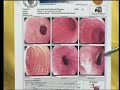 Endoscopia Realizada a Luciana Sandoval El Salvador parte 1