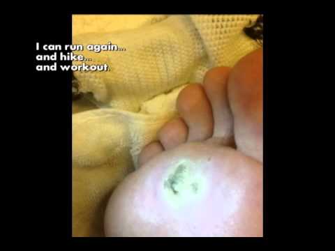 how to cure plantar wart