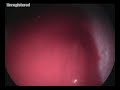 Another bleeding liver biopsy