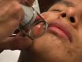 Lasering MiXto Acne Treatment