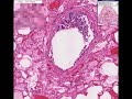 Histopathology Lung--Early pneumonia