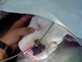 Bloqueio de plexo braquial em cão submetido a osteossíntese Bloqueio de plexo braquial em cão submetido a osteossíntese