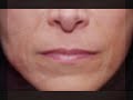 Anti Wrinkle Treatments - Permanent or temporary fillers?