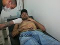 Poniendo piercing en el pezón