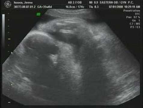 35 weeks pregnant ultrasound sonogram Breech baby