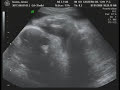 35-weeks-pregnant-ultrasound-sonogram-breech-baby.html