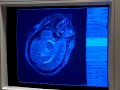 Right Frontal Craniotomy Performed With Image Guidance  Epilepsy Brain