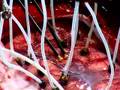 Right Frontal Craniotomy Performed With Image Guidance
