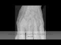 Hand Rejuvenation Hand Rejuvenation