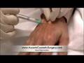 Hand Rejuvenation