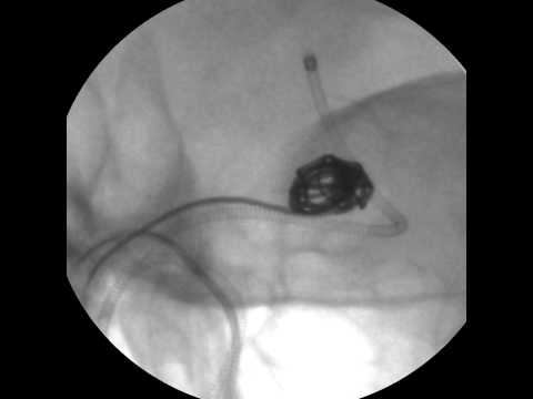 Identification Of Cranial Aneurysms With A Fluoroscope- Part 2