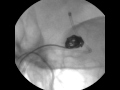 Identification Of Cranial Aneurysms With A Fluoroscope- Part 2 Identification Of Cranial Aneurysms With A Fluoroscope- Part 2