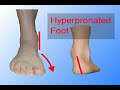 Think you need arch supports or custom orthotics?
