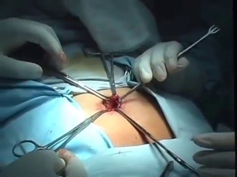 how to recover from umbilical hernia surgery