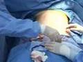 Abdominoplasty / Tummy Tuck Surgery Video